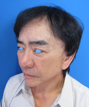 目の下のたるみ、目のくまでお悩みの方、切らずに完璧に解決します。TCB-R法　手術直後　症例写真